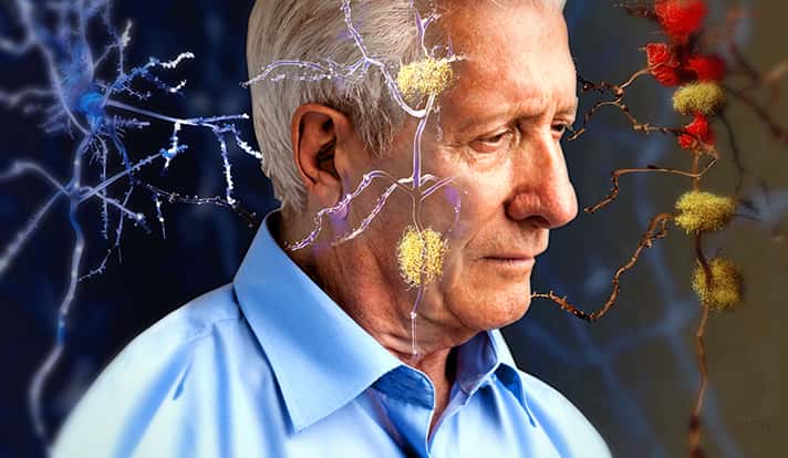 Científicos italianos afirman que el supuesto origen del Alzheimer no está en el área del cerebro asociada a la memoria