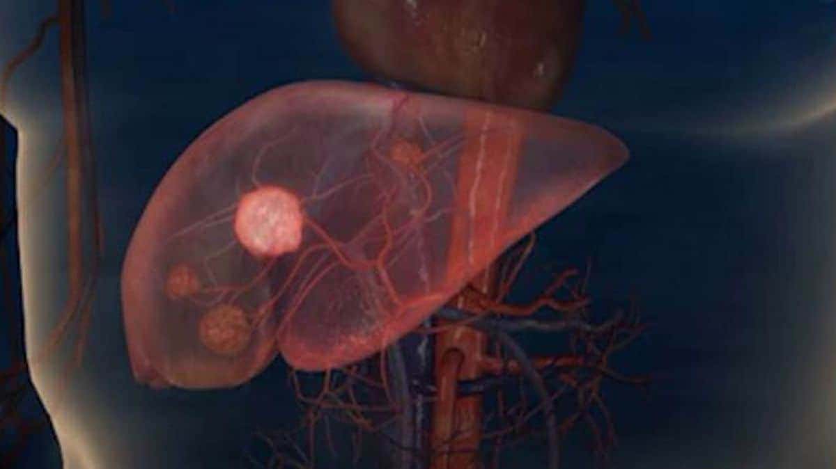 En 2030, el hígado graso causará más cáncer de hígado que la hepatitis