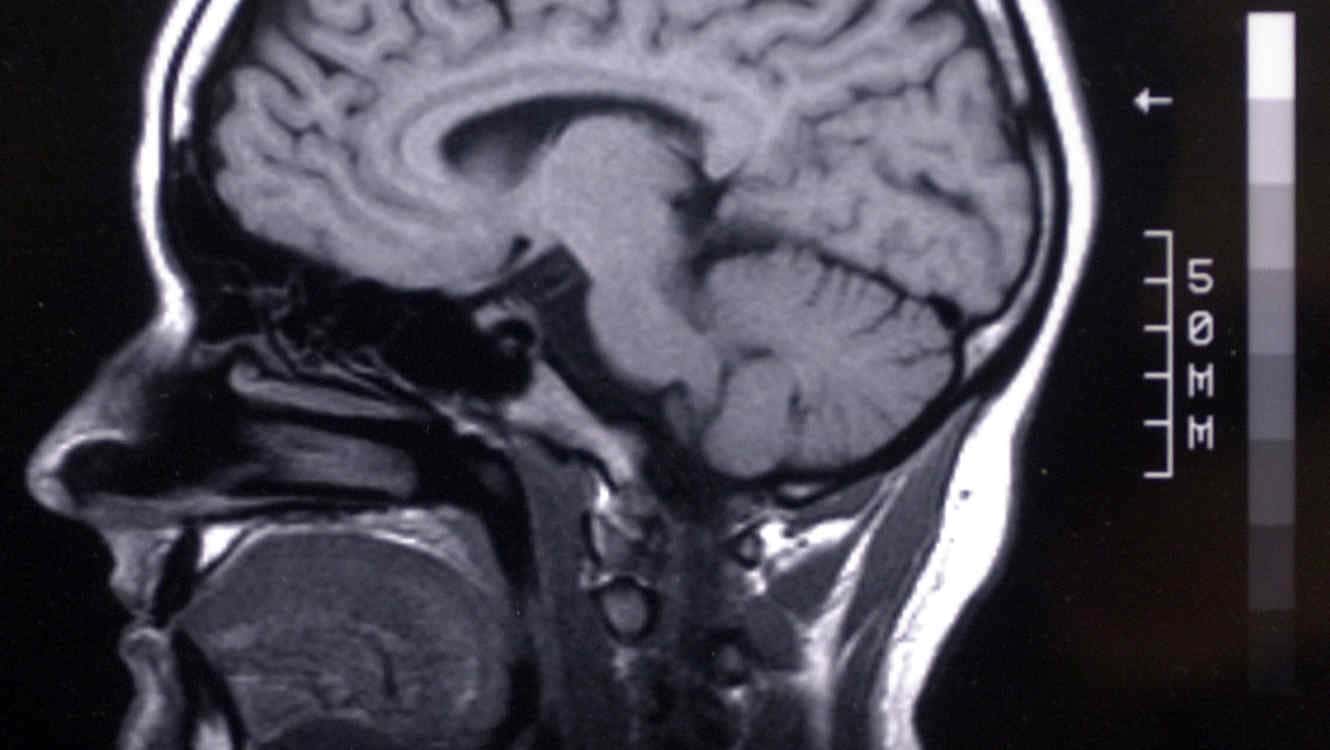 ¿Es evitable el Accidente Cerebro Vascular?