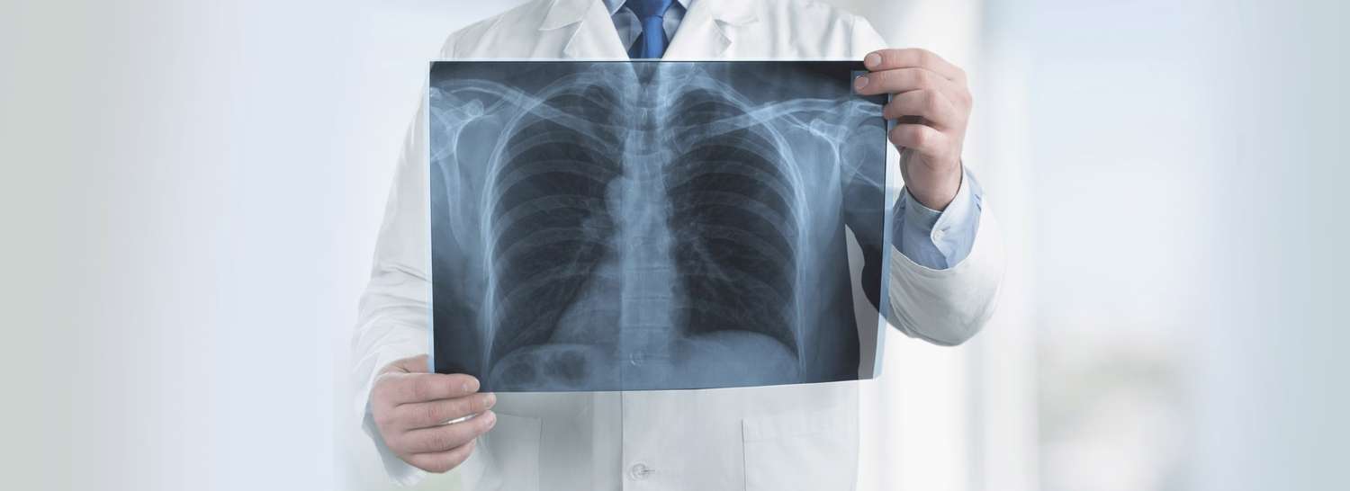 Fibrosis Pulmonar Idiopática, el gran desafío del diagnóstico temprano